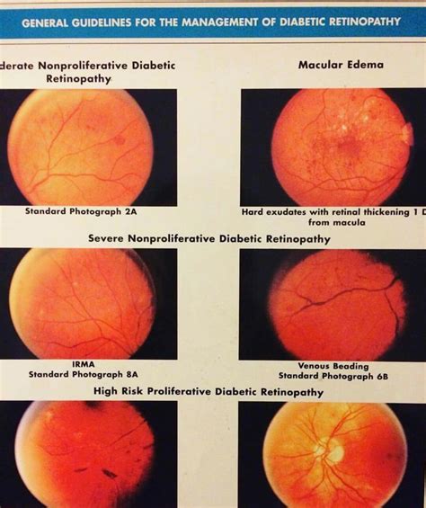 Diabetic Retinopathy Stages Diabetic Retinopathy Eye Care Health Optician Training