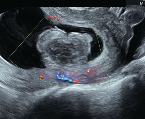 Ultrasound Is A Critical Tool Of Managing Miscarriage Diagnostic Imaging