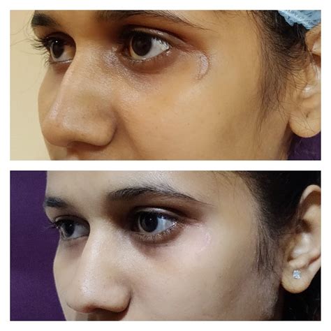 Scar Revision Venkat Center For Skin And Plastic Surgery