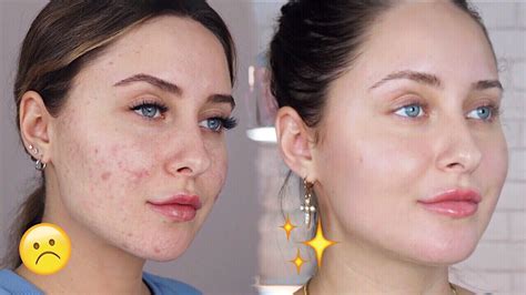 How To Get Rid Of Acne Dark Spots And Scars Youtube Af3