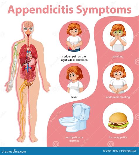 What Is Appendicitis Facts About Appendicitis Infographic