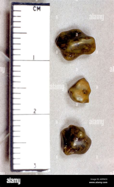 Gallstones Hi Res Stock Photography And Images Alamy