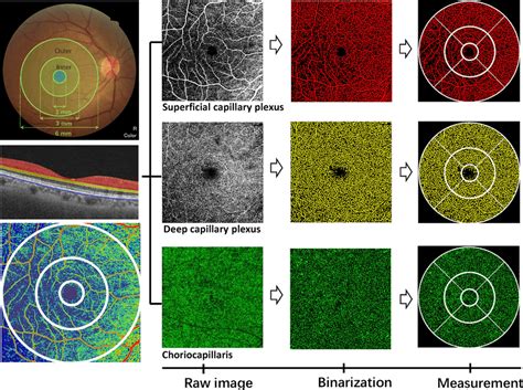 The Swept Source Optical Coherence Tomographic Angiography Provides