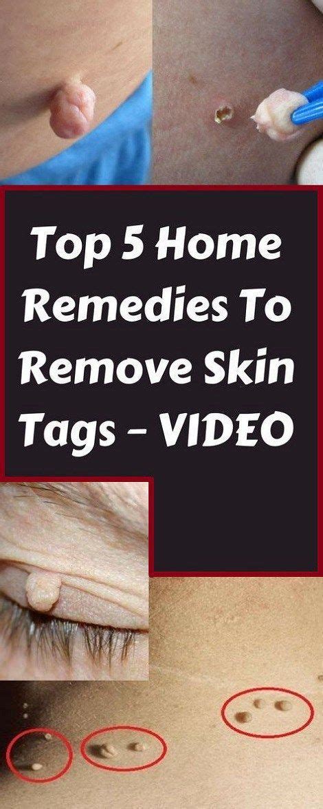how to get rid of skin tags naturally