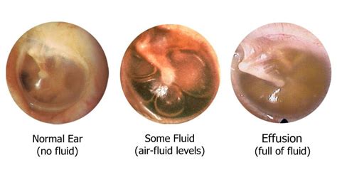 Middle Ear Effusion Otorrino Anatomía Oido