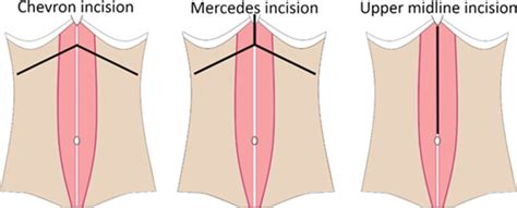 Examples Of Incisions Used In Liver Transplant Recipients Download