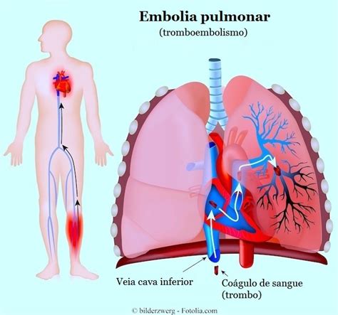 Embolia Pulmonar Sintomas Causas E Tratamento