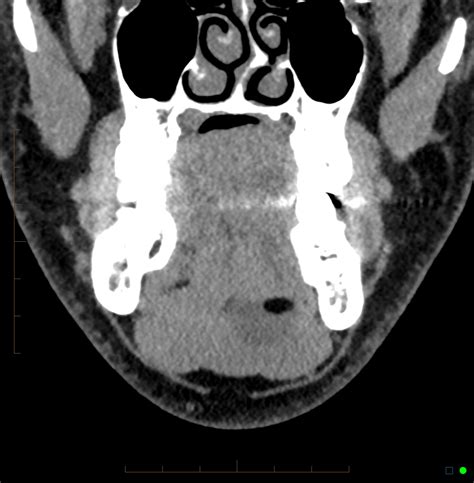 Floor Of Mouth Dermoid Cyst Image