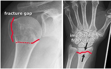 Fracture General Principles Startradiology Types Of Fractures