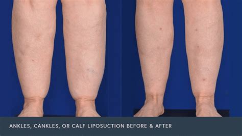 Liposuction For Cankles Cosmetic Surgery Tips