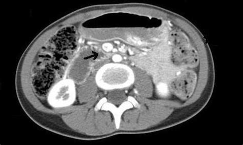 Ct Scan Of The Abdomen And Pelvis With And Without Contrast Hot Sex Picture