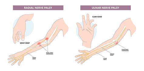 Radial Nerve Anatomy And Function