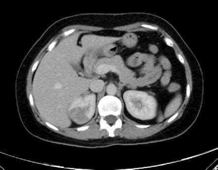 This phase may be helpful to differentiate urothelial cancer from rcc, parapelvic or peripelvic cysts from hydronephrosis, and to diagnose calyceal diverticula. Renal venous infarct | Image | Radiopaedia.org