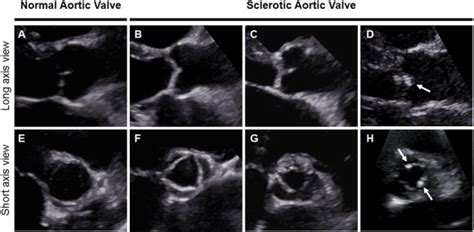 Cardiovascular Morbidity And Mortality In Patients With Aortic Valve