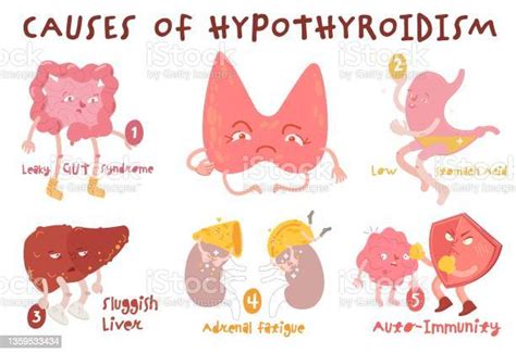 Causes De Lhypothyroïdie Maladie De La Glande Thyroïde Trouble Du Système Endocrinien