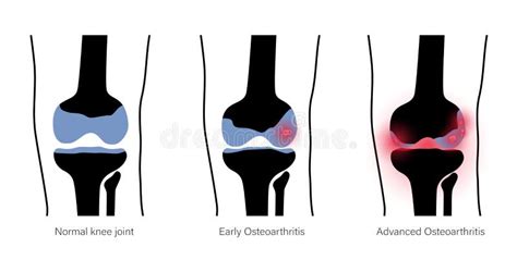 Stages Of Knee Osteoarthritis Oa Stock Vector Illustration Of