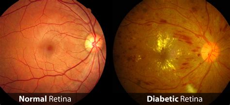 Diabetic Retinopathysymptomscausestreatment And Surgery How To Relief