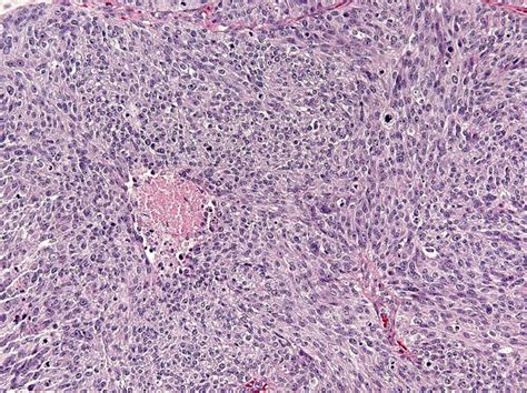 Pathology Outlines High Grade Serous Carcinoma