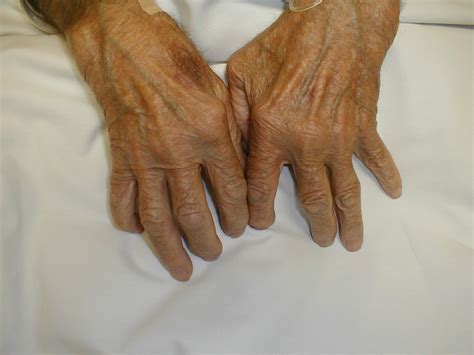 Clinical Picture Of Rheumatoid Arthritis Symptoms And Signs ~ Med2date