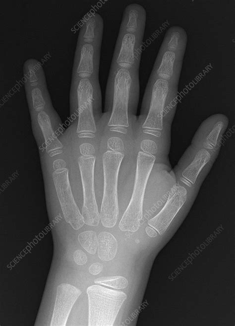 Childs Hand Normal X Ray Stock Image C0393318 Science Photo