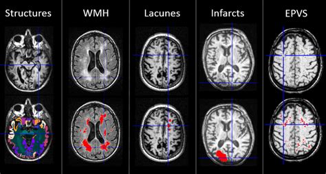 Global Burden Of Small Vessel Diseaserelated Brain Changes On Mri