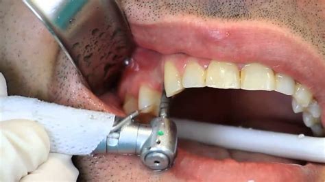 Tempo De Tratamento De Um Implante Dentário