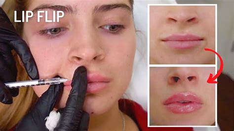 Before And After Natural Botox Lip Flip Ft Carrington Durham Youtube