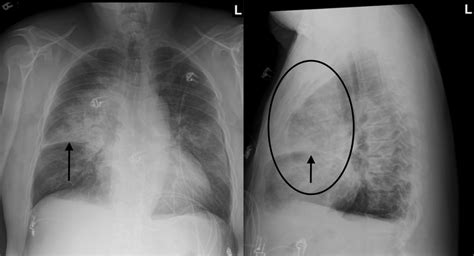 Condition Specific Radiology Pneumonia Stepwards