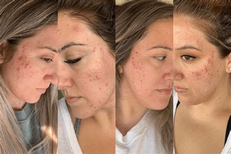 How I Healed My Hormonal Acne