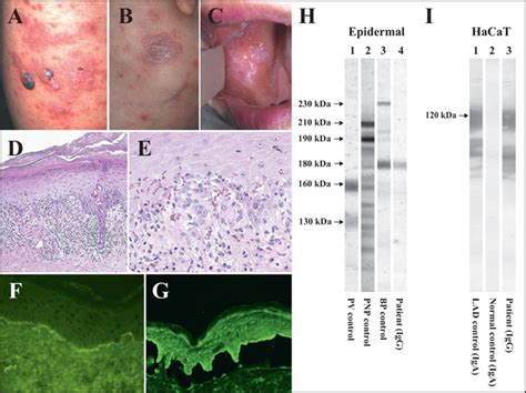 John Libbey Eurotext European Journal Of Dermatology Lichen Planus Pemphigoides Concomitant