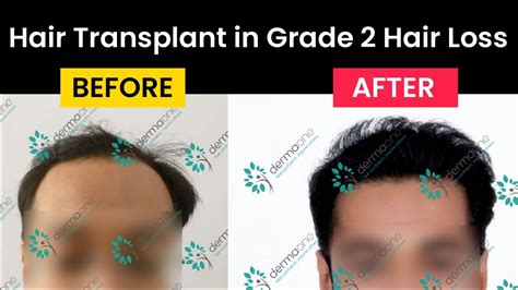 Fue Hair Transplant In Grade 2 Baldness Hair Loss Grade 2 Male