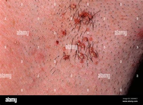 Warts On The Neck Of A 27 Year Old Man These Contagious But Harmless