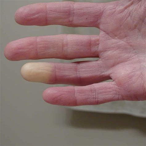 Scleroderma Skin Complications And Treatments Raynauds Phenomenon