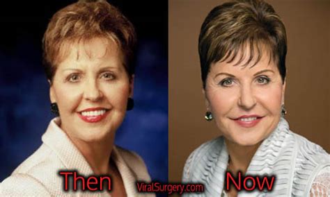Joyce Meyer Plastic Surgery Before And After Facelift Pictures