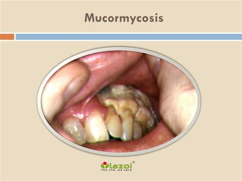 It is ubiquitous and found in soil and air and even in the nose and mucus of healthy people, says dr nair. PPT - Mucormycosis: Causes, Symptoms, Daignosis ...