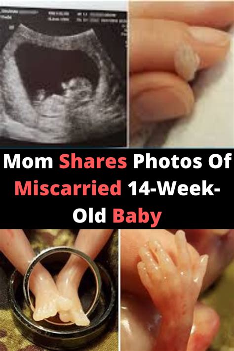 What Do A Miscarriage Look Like Medcoo