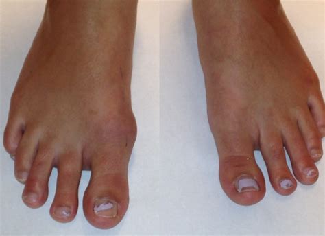 Post Traumatic Hallux Valgus A Rupture Of The Medial Collateral