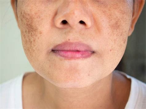 What Is A Pregnancy Mask Melasma And What Can You Do About It