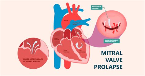 Mitral Valve Prolapse Symptoms Diagnosis And Treatment Oklahoma