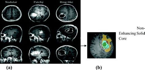 Sample Abnormal Brain Activity Prediction Using Egnnn Download