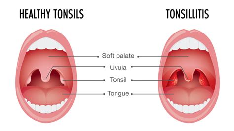 Tonsillitis Getcured Apothecary Pvt Ltd