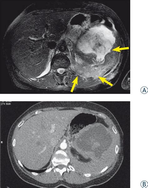 Mri And Ct Images Of The Same Patient A T2 Fs Weighted Mri Image In