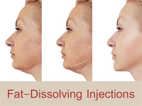 Fat Dissolving Injections Dissolves Cheek Fat Med Art