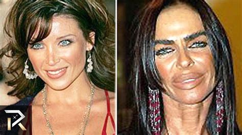 Top Botched Plastic Surgery Fails Plastic Surgery Before And Vrogue