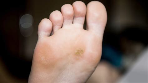 Corns And Calluses Morecrofts Podiatry Services Lilydale