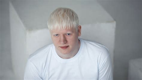 Albinizm Albinos Wrodzony Brak Barwnika Przyczyny Leczenie