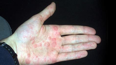 What Is Dyshidrotic Eczema Blisters On Fingers Hands