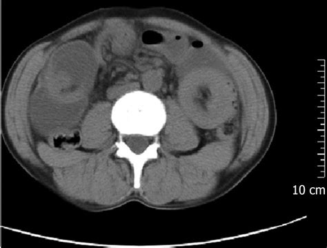 Case report colocolonic intussusception of a giant pseudopolyp in a patient with ulcerative colitis a case report and review of the literature thomas s. Adult intussusception: A retrospective review of 41 cases