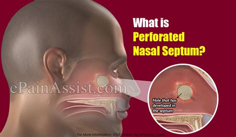 What Is Perforated Nasal Septum Symptoms Causes Diagnosis Treatment