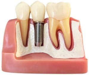 De même, elle permet à votre patient d?être informé de manière claire et plus précises sur les étapes de son plan de traitement. Dental implant model - Vaughan Children's Dentistry